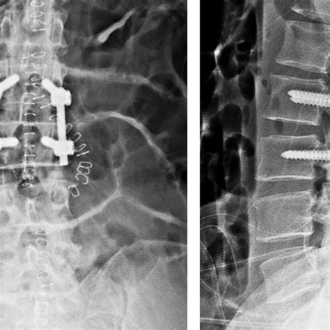 Anteroposterior A And Lateral B Radiographs Of The Lumbar Spine