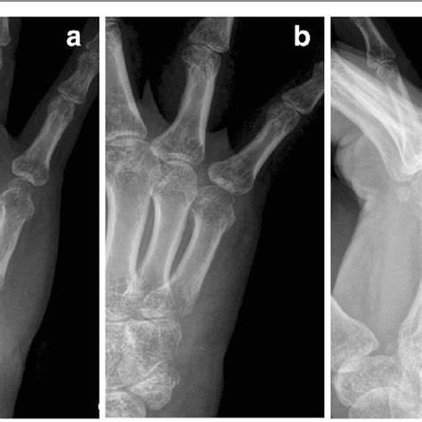 Typical Fifth Metacarpal Neck Fracture Is Shown Preopepratively In The