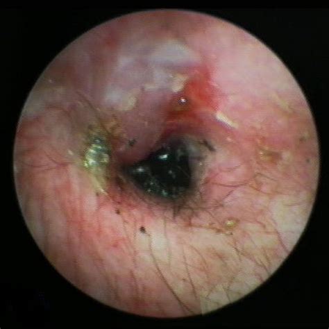 When water or debris such as dirt or sand penetrates the ear canal, bacteria or fungus might be deposited and can multiply, causing infection and inflammation. Video Otoscope Procedures at the Ear Clinic for Pets
