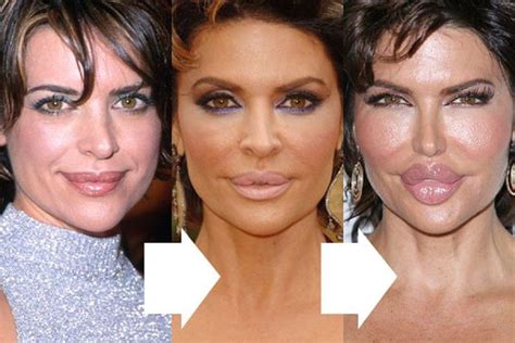 Lisa Rinna Facelift Lip Injection And Cheek Implan Celebrity Plastic