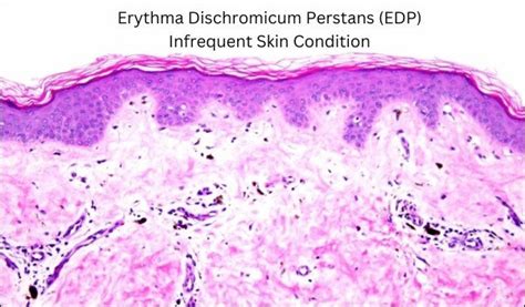 Erythema Dyschromicum Perstans Treatment In Ayurveda
