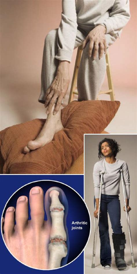 Rheumatoid Arthritis Ra Of The Foot And Ankle Arthritis Foundation
