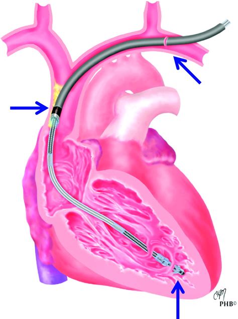 Pacemaker And Defibrillator Lead Extraction Circulation