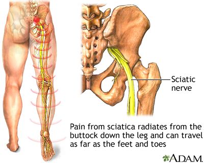 Graeff Chiropractic Clinic Chiropractor In Temple Tx Us Sciatica