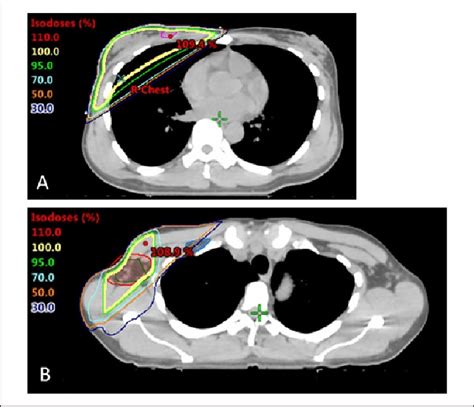 Radiation Treatment Plans A Right Chest Axilla And Supraclavicular