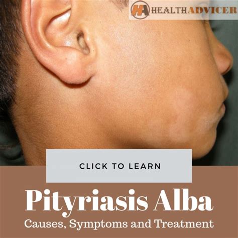 Pityriasis Alba Causes Picture Symptoms And Treatment