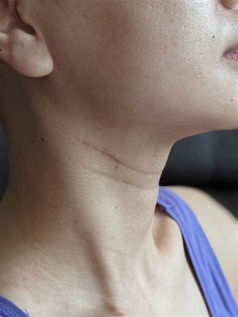 Swollen Lymph Nodes In The Neck Dr Jeeve Ent Specialist
