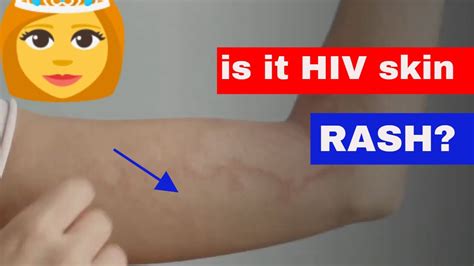 Hiv Aids Rash Pictures Symptoms And Treatment Vrogue Co
