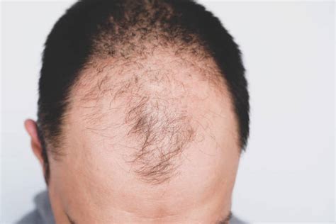 Hair Transplant Clinic Hair Loss Specialist Best Surgeon Lahore