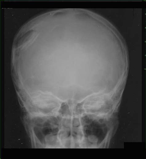 Depressed Skull Fracture On X Ray X Rays Case Studies Ctisus Ct