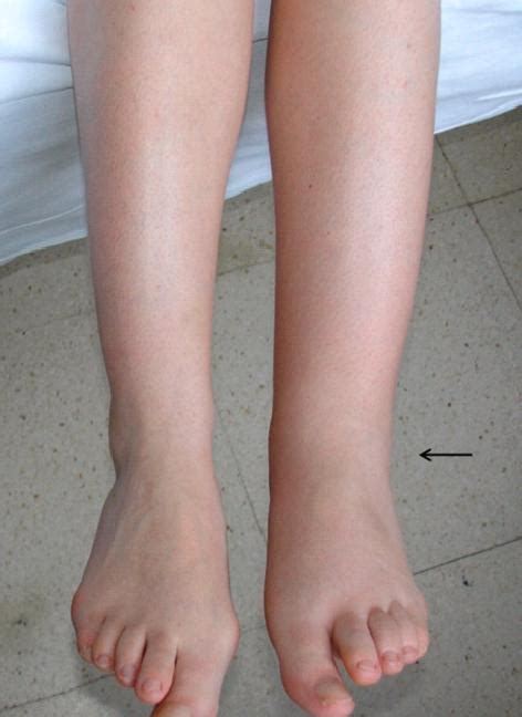 Leg Swelling Causes And Prevention Common Medical Questions