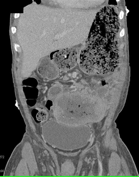 Large Ulcerating Gist Tumor With Liver Metastases Gastrointestinal