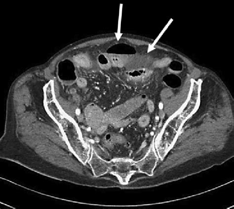 Ct Scan Of Abdomenpelvis With Evidence Of Free Air With Free Fluid