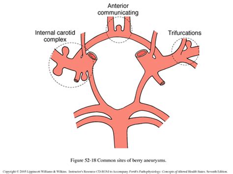 Aneurysms are bulging blood vessels in the body that can lead to rupture, leaking, and death. Cerebral Aneurysm » Lillian S. Wells Department of ...