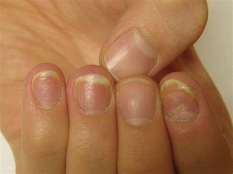 Psoriasis Of The Nails Images Tutor Suhu