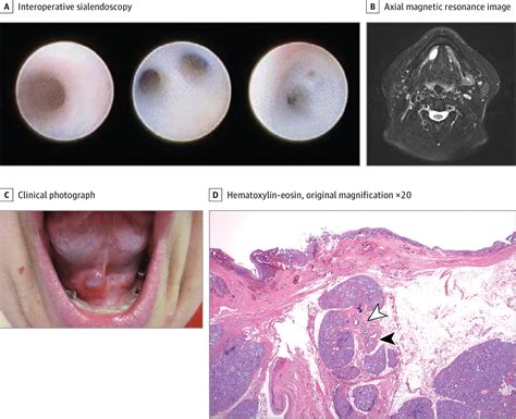 Floor Of Mouth Swelling Radiology Jama Otolaryngologyhead And Neck