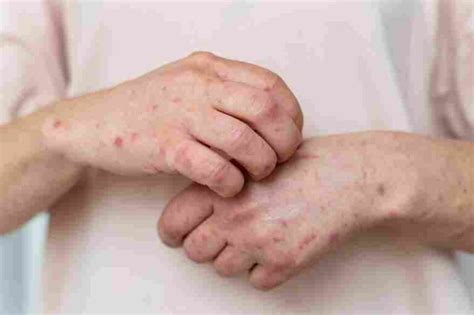 Types Of Eczema Symptoms And Treatment