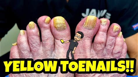 Cutting Insanely Yellow Toenails With Fungus Youtube