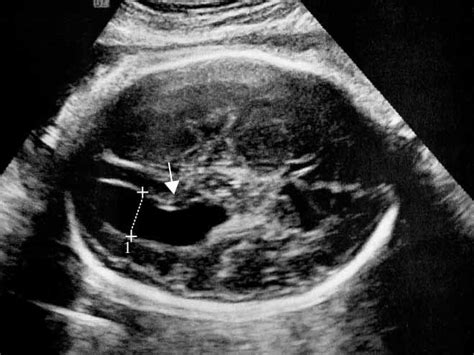 Ventriculomegaly Ultrasound