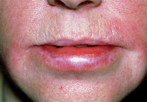 Angioedema Of The Lips Due To An Allergic Reaction Photograph By Dr P Marazziscience Photo Library
