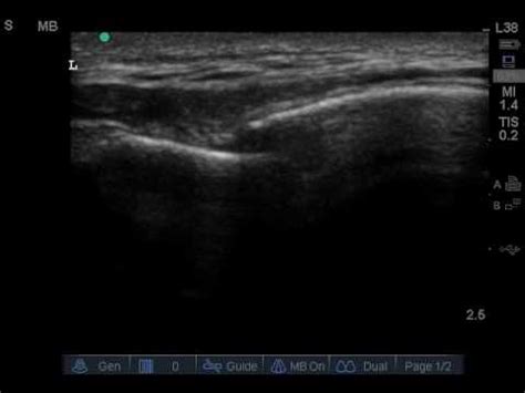 Video 3 Sternal fracture with step-off - YouTube