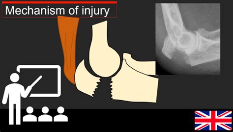 Understanding Olecranon Fractures