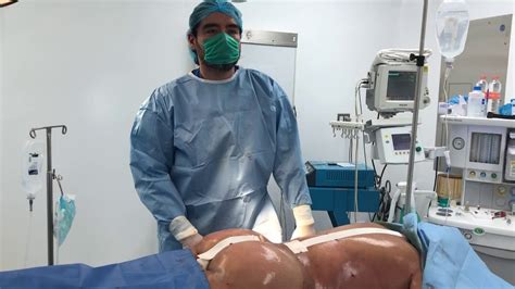 Bbl Brazilian Butt Lift Viveplasticsurgery Dr Guadalajara Youtube