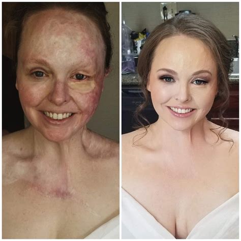 Before And After Makeup On My Bride That Was Victim Of An Awful Burn Bridalmakeup