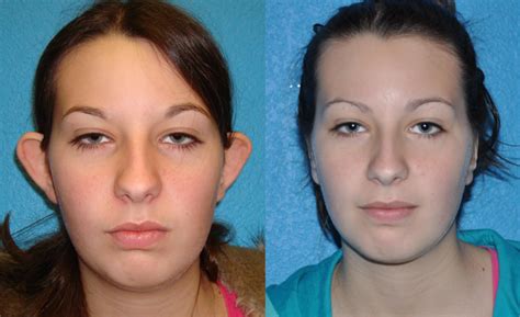 Otoplasty Plastic Surgery Before And After Photos Fort Worth Ears Dallas