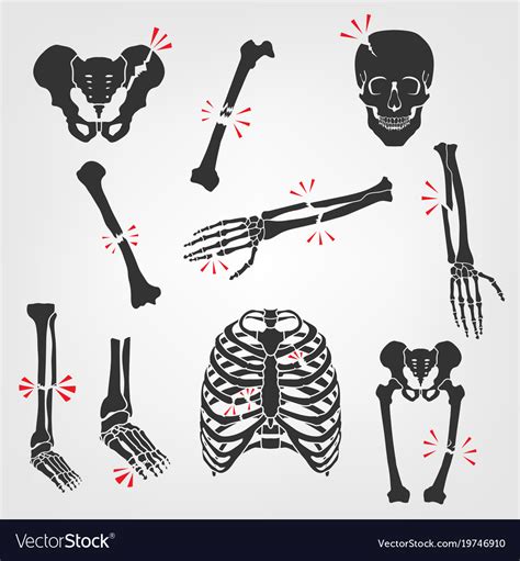 Bones Fractures Icons Royalty Free Vector Image