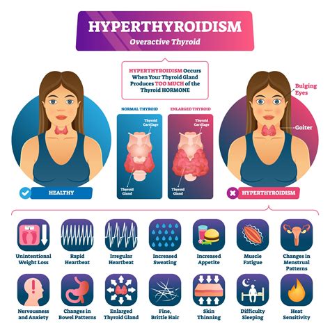 Hyperthyroidism Symptoms Signs You Have An Overactive Thyroid Hot Sex Picture