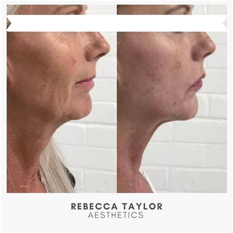 Dermal Fillers Suffolk Facial Aesthetics Rebecca Taylor Aesthetics