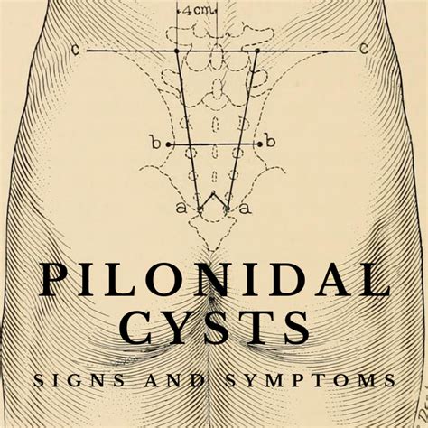 Painful Bump On Your Tailbone Symptoms Of A Pilonidal Cyst Youmemindbody