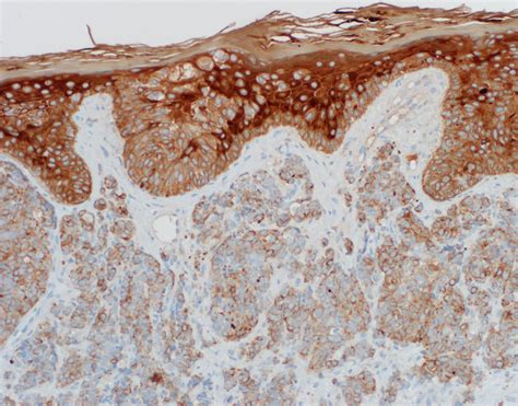 Merkel cells are cells that lie in the middle layers of the skin. Pathology Outlines - Merkel cell carcinoma