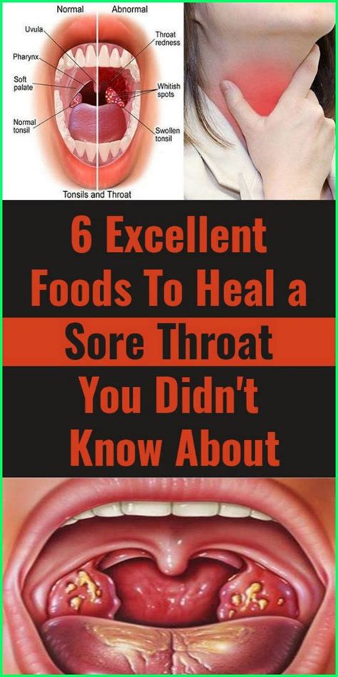 Accidentally biting the inside of your cheek, sensitivity to certain foods or hormonal fluctuations during menstruation can cause canker sores. 6 Foods That Can Help You Heal Sore Throat | Heal sore ...