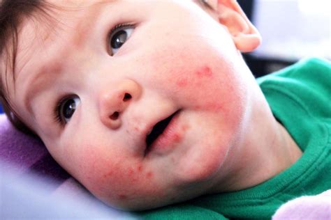 Ask The Doc Im Worried About My Childs Rash What Should I Do