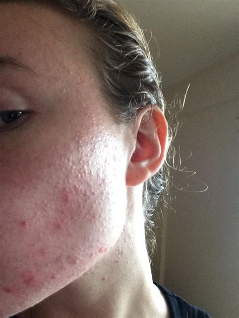 Aug 28, 2020 · acne vulgaris is characterized by comedones, papules, pustules, and nodules in a sebaceous distribution (eg, face, upper chest, back). Comedonal acne?? - General acne discussion - Acne.org