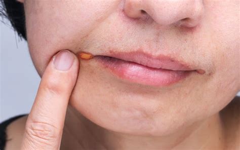 Rash Around Mouth 17 Common Causes And Home Remedies