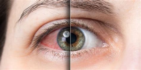 Common Causes Of Eye Discomfort And How To Treat Them Year Tearm