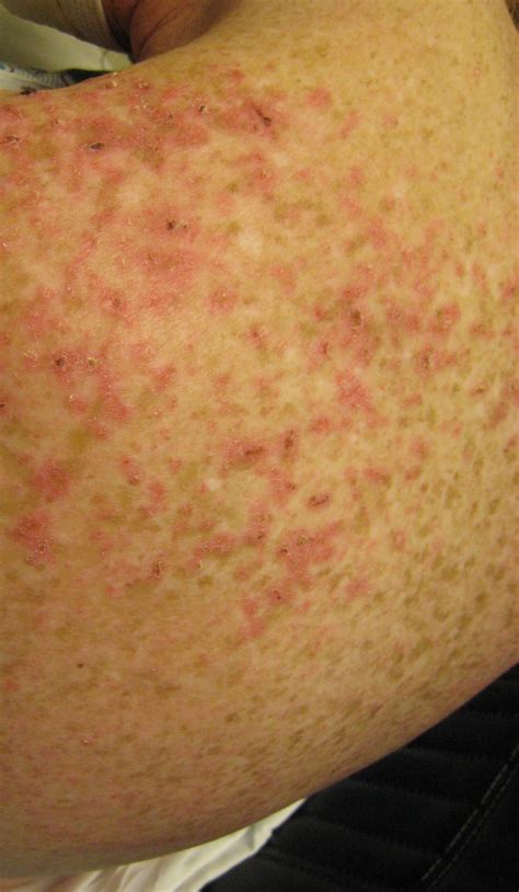 Lupus Rash What It Is And How To Treat It Goodrx