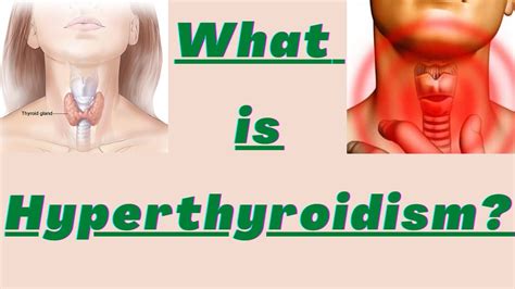 Hyperthyroidism And Its Causes Risk Factors Diagnosis Management In Nepali Youtube