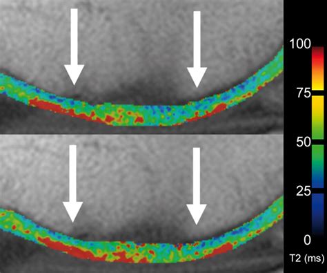 Quantitative T2 Mapping Of Knee Cartilage Differentiation Of Healthy