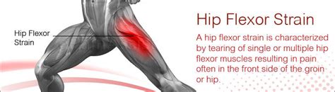 Hip Flexor Strain Types Causes Symptoms Treatment Exercise My XXX Hot