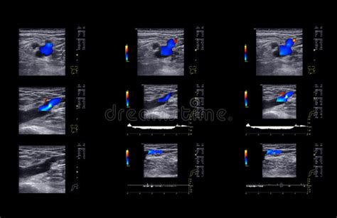 Ultrasound Doppler For Finding Deep Vein Thrombosis Stock Image Image