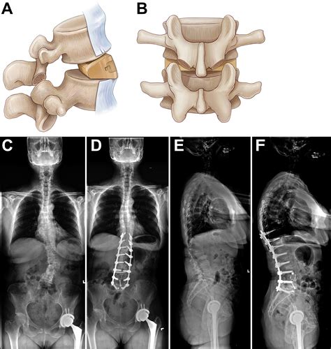 The Comprehensive Anatomical Spinal Osteotomy And Anterior Column