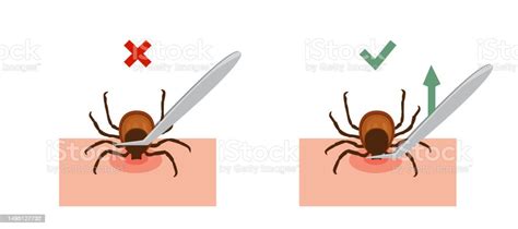 Correct Way To Remove Tick Of Skin After Bite Insect Correctly Vector
