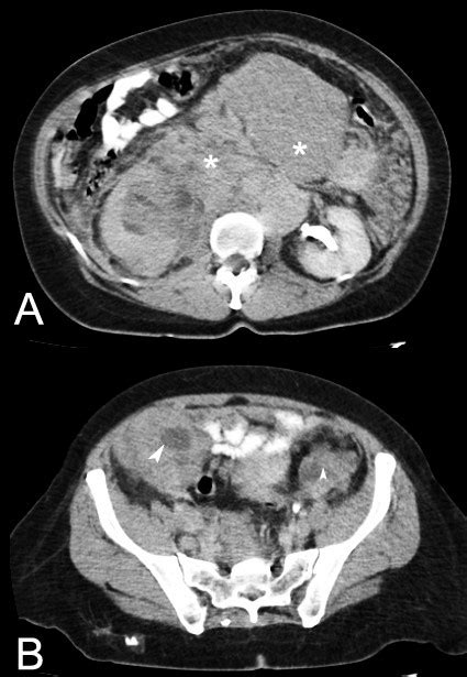 A Contrast Enhanced Ct Scan Of The Abdomen Showing Retroperitoneal