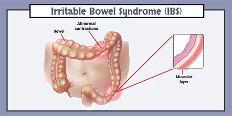 What is Irritable Bowel Syndrome? | Tips to cope with IBS ...