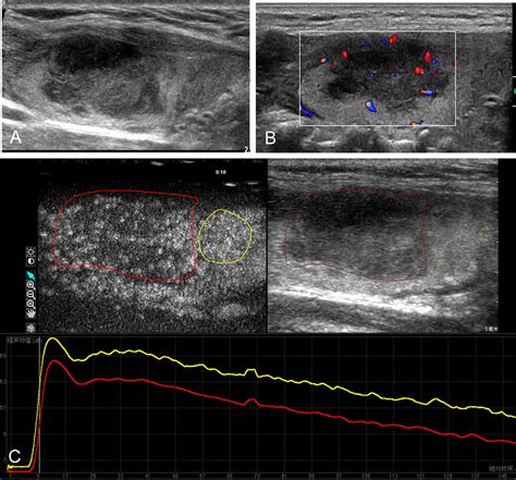 Frontiers Contrast Enhanced Ultrasound In The Differential Diagnosis