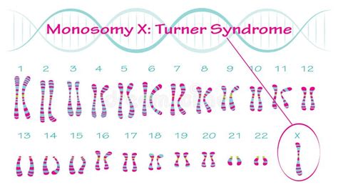 Monossomia X Cariótipo Da Síndrome De Turner Ilustração do Vetor